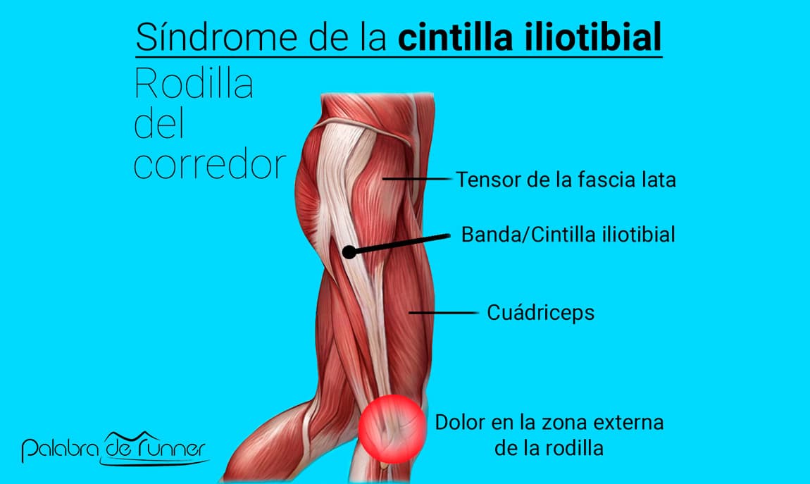 Sindrome de la cintilla iliotibial y fascia lata