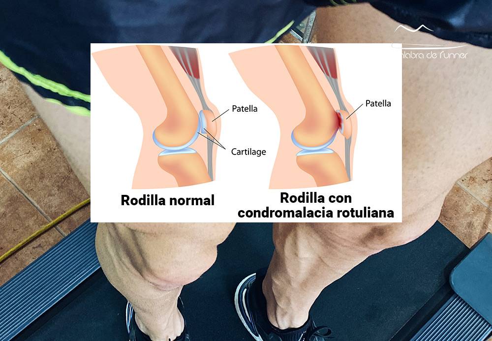 Condromalacia Rotuliana tratamiento