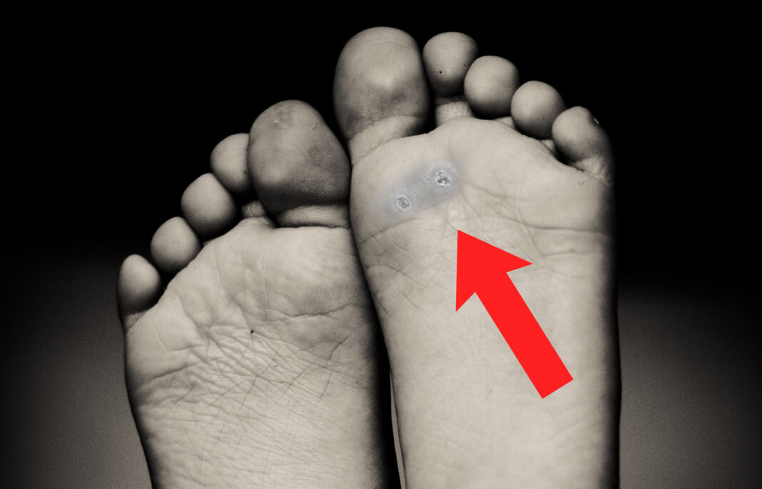 Papiloma en el pie o verruga plantar lo que debes saber Papiloma en el pie o verruga plantar lo que debes saber